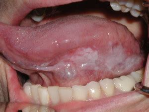 Got white spot on you tongue? Leukoplakia - Lichen Planus of the tongue - Dr. Caputo ...