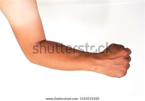 Arm Two Tone Skin Sunburn Stock Photo 1163519260 Shutterstock