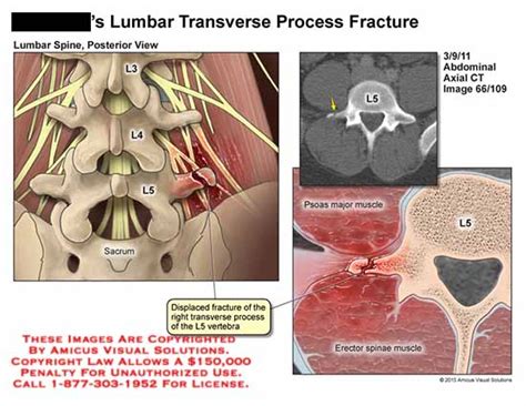 AMICUS Illustration Of Amicus Injury Fracture Transverse Process Lumbar