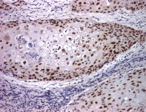 Moderately Differentiated Squamous Cell Carcinoma P53 Download