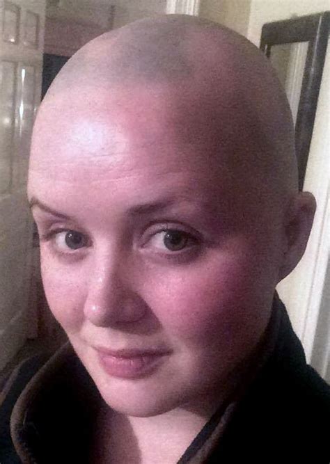Brave Alopecia Sufferer Shaves Head After Documenting Hair Loss Journey