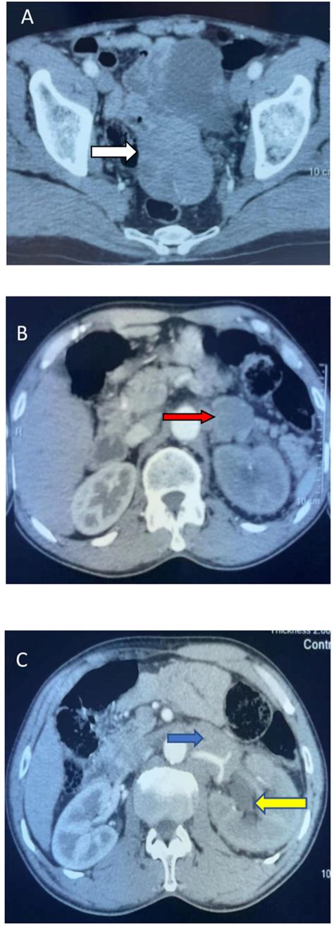 Axial Sections Of Ct Scan Depicting A 7cm Pelvic Mass 1 A White