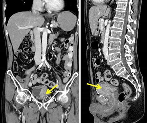 Urinary Bladder Carcinoma Radiology Cases