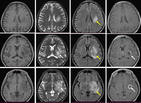 Cerebral Abscess Radiology Cases
