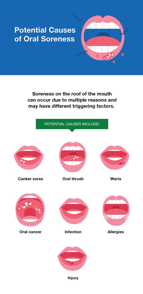 Sore Roof Of Mouth Causes And Treatment Smartmouth