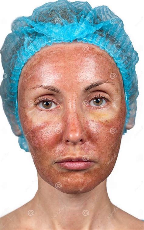 Skin Condition After Chemical Peeling Tca Face Stock Photo Image Of
