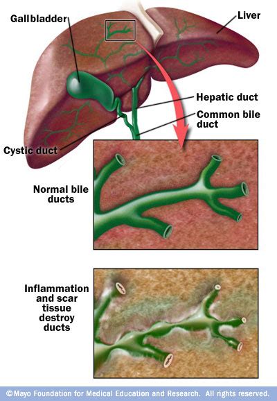 Primary Sclerosing Cholangitis Canadian Liver Foundation