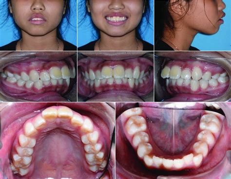 Comprehensive Orthodontic Treatment In An Adolescent Patient With Class