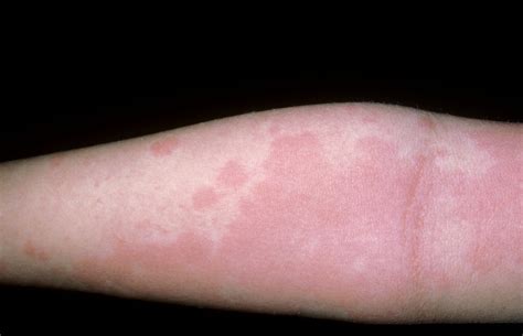 Urticaria Hives Causes Symptoms Diagnosis And Treatment