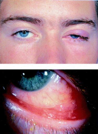 Parinauds Oculoglandular Syndrome Attributable To An Encounter With A