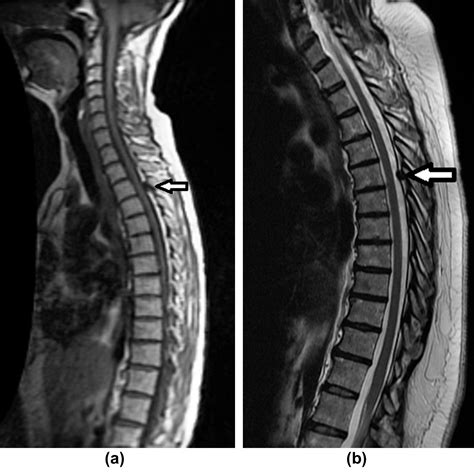 Mri Based Anatomical Landmarks For The Identification Of Thoracic Vertebral Levels Clinical