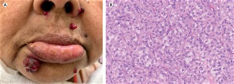 Cutaneous Metastasis Of Renal Cell Carcinoma The Lancet Oncology