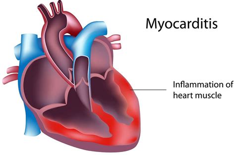 Myocarditis Causes Symptoms Recovery Time Diagnosis And Treatment