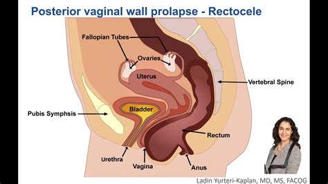 What Is Posterior Vaginal Wall Prolapse Youtube