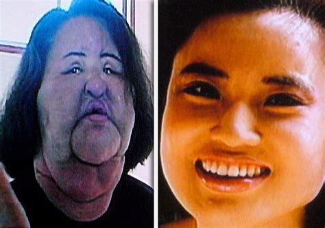 plastic surgery addict injects cooking oil into her own face bollywood news india tv
