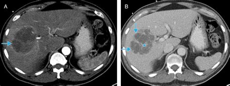 The Evolving Nature Of Hepatic Abscess A Review