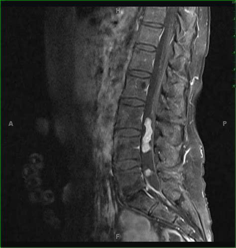 Lumbar Spinal Schwannoma Neuro Mr Case Studies Ctisus Ct Scanning