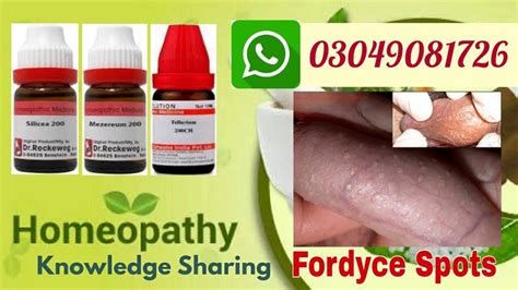 Fordyce Spots Homeopathic Treatments Risk Factors And Symptoms