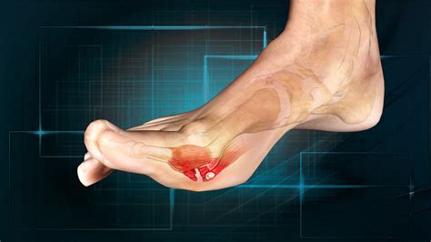 Turf Toe Causes Symptoms Diagnosis And Treatment Natural Health News