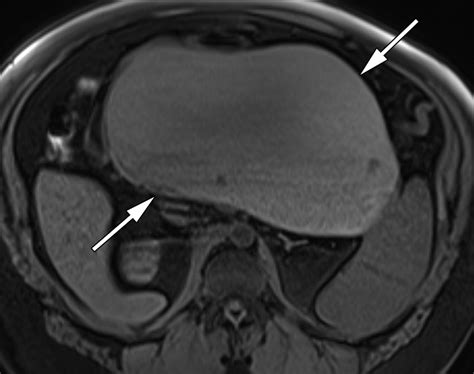 Mr Imaging Of Cystic Lesions Of The Pancreas Radiographics