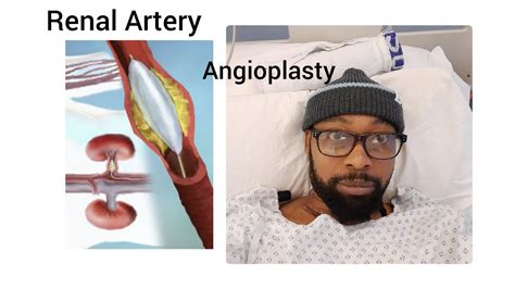 Renal Artery Angioplasty Procedure Eric Kita Youtube