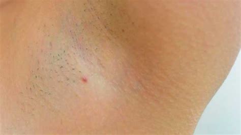Ingrown Armpit Hair Lymph Node Pictures Lump How To Get Rid Home