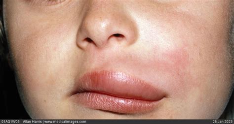 Angioneurotic Edema Of Lips