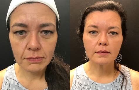 Juvederm Before And After Juvederm Rejuvenation W Before After