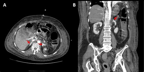 Bilateral Adrenal Gland Hyperenhancement Pacs