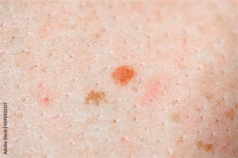 Foto Stock Mole Birthmark Nevus Macro Photo On Human Skin Crochordon