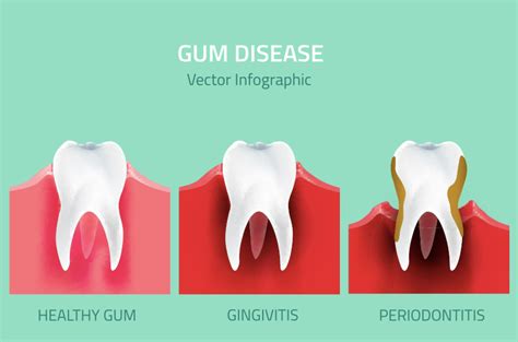 Why Do Gums Bleed And How You Can Cure Your Bleeding Gums All You Need