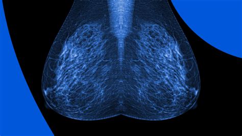 Mammograms And 5 Other Types Of Breast Screening Exams Pockethealth