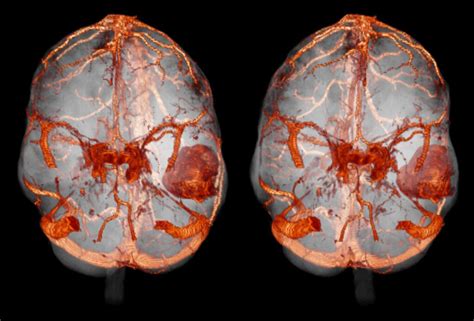 Brain Metastasis Melanoma 2 Volume Rendering Of An Mri S Flickr
