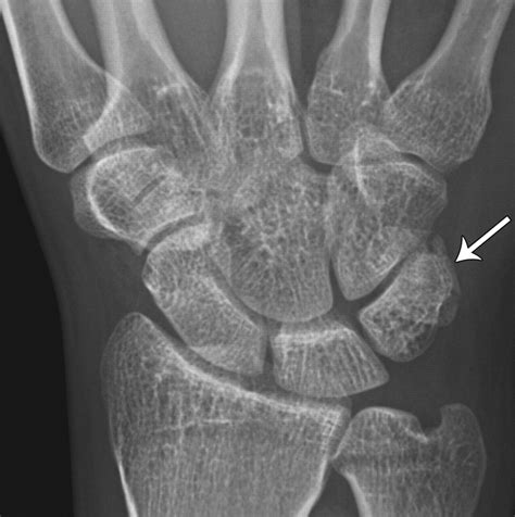 Multidetector Ct Of Carpal Injuries Anatomy Fractures And Fracture Dislocations Radiographics