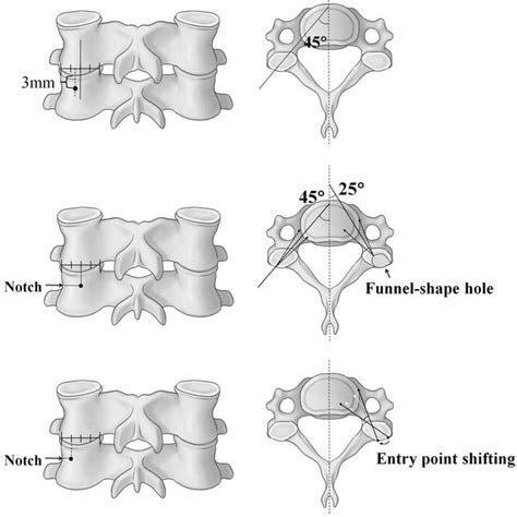 Various Entry Points And Trajectories For Subaxial Cervical Pedicle Download Scientific Diagram