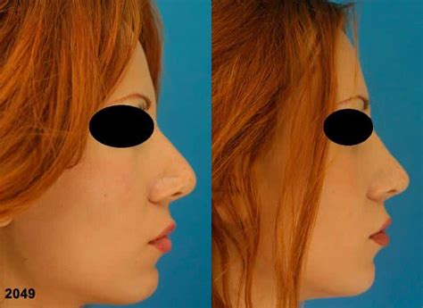 8 Common Signs Of A Bad Rhinoplasty Philip Miller Md