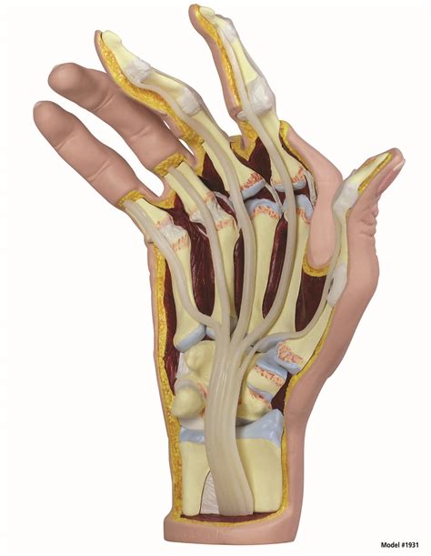Hand Rheumatoid Arthritis Ra Anatomical Model