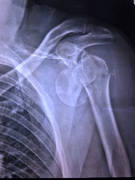 Le fratture di omero prossimale | MEDICITALIA.it