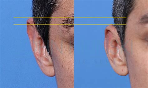Macrotia Ear Reduction Front View Changes World Expert In Making Ears