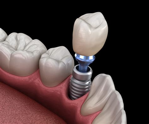 How Long Do Dental Implants Last Graceful Smiles Dentistry