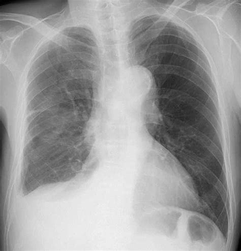 Figure1 Chest X Ray Demonstrated Diffuse Thickening Of The Right Pleura