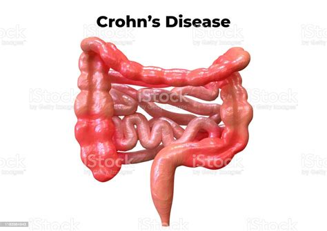 Crohns Disease Is A Syndrome That Affects The Digestive System Its