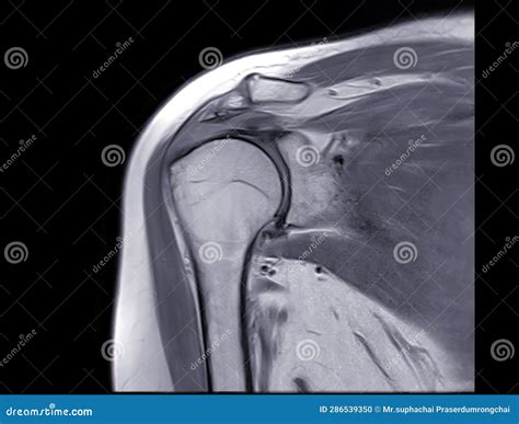 Magnetic Resonance Imaging Or Mri Of Shoulder Joint Coronal Pdw For