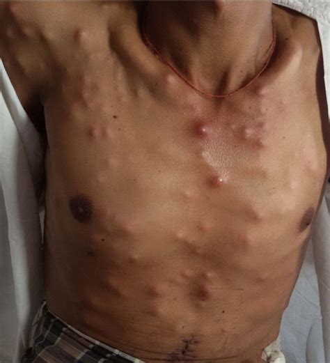 Multiple Metastatic Subcutaneous Nodules Over The Anterior Chest Wall