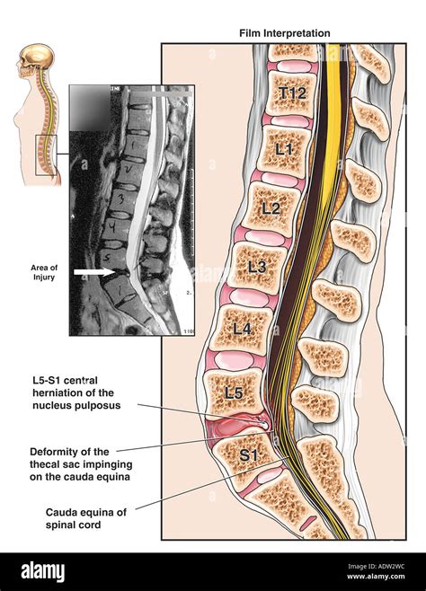 Spinal Cord Injury L5 S1 Disc Herniation With Compression Of Cauda
