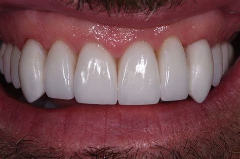 Vampire Teeth Fang Feels Cosmetic Dentist Auckland