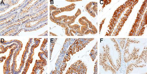 Expression Of Immunohistochemical Markers In Tumor Cells Muc1 In The
