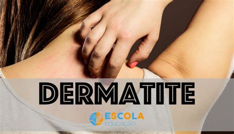 Dermatite O Que Causas Sintomas Tratamento Tipos The Best Porn