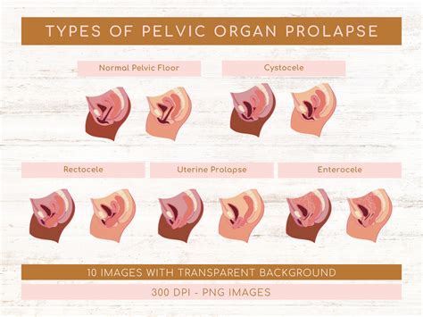 Types Of Pelvic Organ Prolapse Rectocele Stages Cystocele Etsy Australia