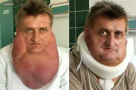 Photos This Man Had A 13 Pound Tumour Removed After Battling A Rare